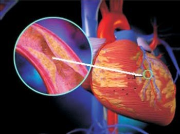 Cơ tim thiếu ô xy: Đại lượng huyết dịch chảy về đại não và phần mặt sẽ làm cho huyết dịch cung ứng cho tim giảm bớt từ đó dẫn đến cơ tim thiếu ô xy. Tim để đáp ứng nhu cầu cơ thể, chỉ có cách làm việc gấp lên nhiều lần, từ đó làm cho nhịp tim không đập nhịp nhàng.