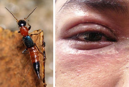 Kiến ba khoang và tổn thương ở mắt do kiến gây nên.