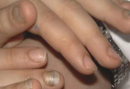 11. Thay đổi ở móng: Một dấu hiệu khác ở giai đoạn muộn nhiễm HIV là thay đổi ở móng tay chân, chẳng hạn móng dày lên, cong queo, móng bị chẻ, hoặc biến màu (có các sọc đen, nâu nằm dọc hoặc ngang).