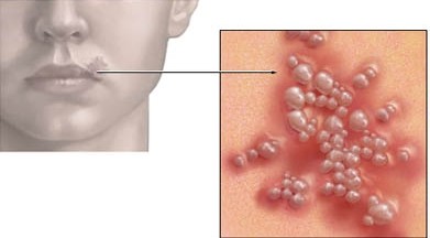 14. Herpes ở miệng hoặc cơ quan sinh dục: Chúng có thể là dấu hiệu của giai đoạn cửa sổ và cả giai đoạn cuối nhiễm HIV. Người mang HIV thường có xu hướng có nhiều đợt bùng phát herpes nghiêm trọng hơn bình thường do HIV làm suy yếu hệ miễn dịch. Bản thân việc bị herpes cũng là một yếu tố nguy cơ nhiễm HIV.