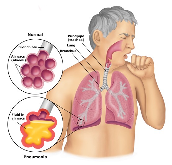 Lười đánh răng gây ra bệnh viêm phổi: Những nghiên cứu gần đây của trường Y thuộc Đại học Yale (Mỹ) và Hiệp hội sức khỏe nha khoa Anh cho rằng vi khuẩn đường miệng là một trong những nguyên nhân làm tăng khả năng mắc bệnh viêm phổi. Những người lớn tuổi và thanh thiếu niên là hai đối tượng dễ mắc các bệnh liên quan tới đường hô hấp nếu vệ sinh răng miệng không tốt.