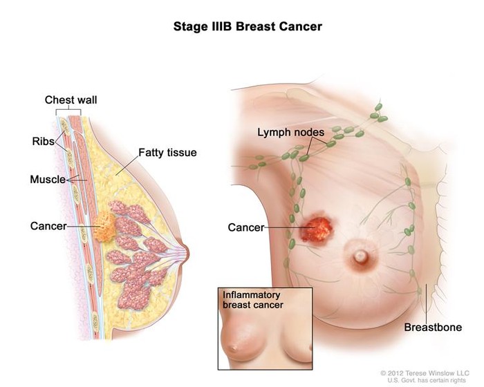 Cứ 8 người phụ nữ thì có 1 người được chẩn đoán mắc ung thư vú