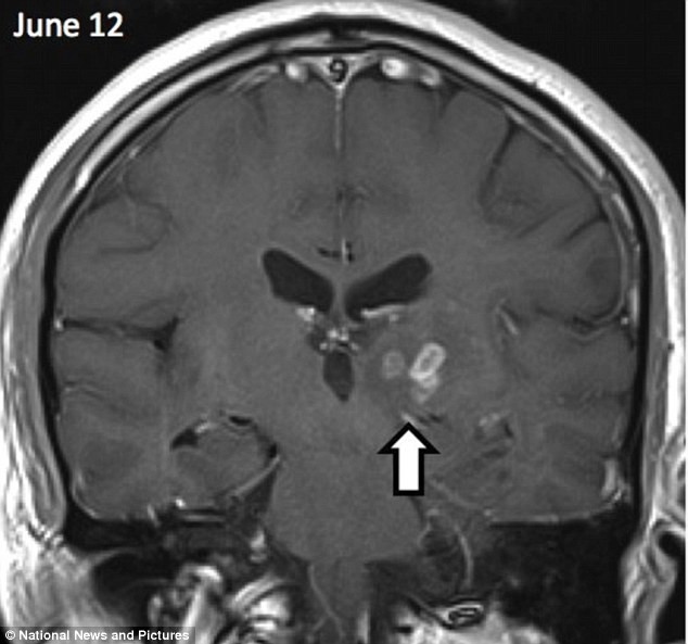 Con sán dài 5cm di chuyển từ bán cầu não phải sang bán cầu não trái của người đàn ông (Ảnh: Dailymail)