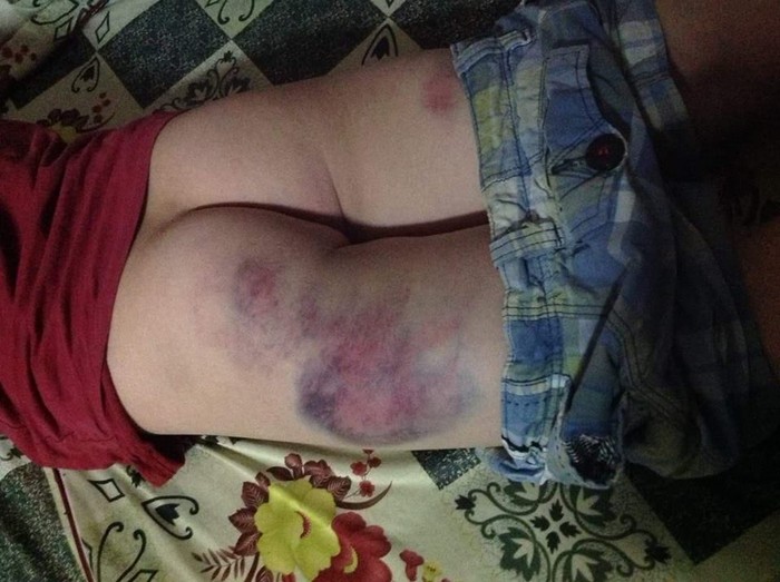 Hình ảnh học sinh bị bầm mông được đăng tải trên mạng xã hội. (Ảnh: H.L)