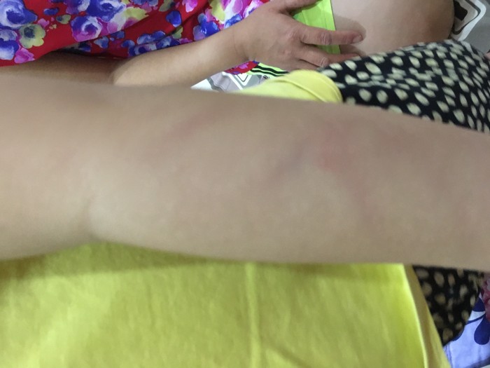 Vết trầy xước trên tay của học sinh do bị cô giáo bạo hành. (Ảnh: Gia đình nạn nhân cung cấp)