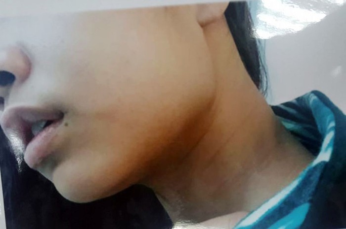 Vết bầm trên cổ cô gái khi bị đối tượng khống chế để giở trò đồi bại. (Ảnh: Gia đình nạn nhân cung cấp)