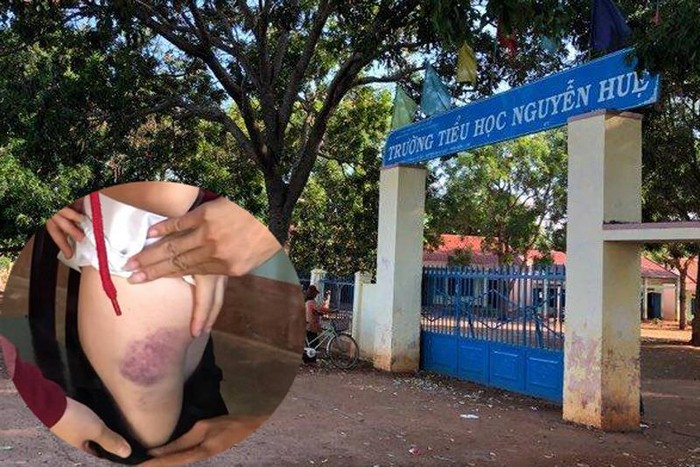 Trường Tiểu học Nguyễn Huệ và vết thương bị bầm trên mông nữ sinh (ảnh nhỏ) do bị cô giáo đánh. (Ảnh: H.L)