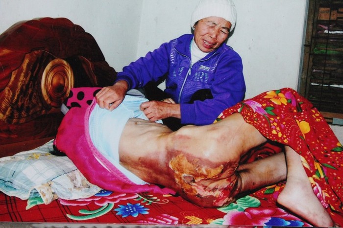 Ông Thịnh (chồng bà Trần Thị Tuyết Minh) đã "choáng" khi nhìn thấy vết bỏng nặng trên người bà Phương