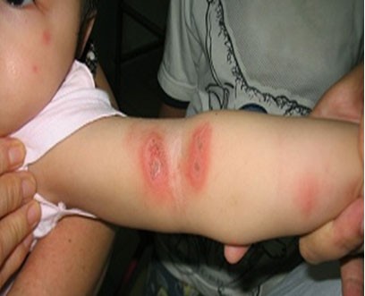Kiến ba khoang độc hơn nhiều loại côn trùng khác nên tổn thương trên da bệnh nhân thường nặng hơn. Ảnh: C.P.