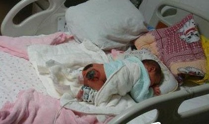 Em bé Shuaishuai bị bỏng nặng ở mông. Ảnh: Internet