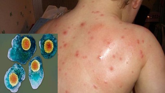 Virut Varicella zoster gây bệnh thủy đậu (ảnh nhỏ) và tổn thương do thủy đậu trên da (ảnh lớn) .