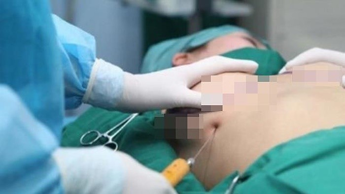 Thai phụ tử vong vì nâng ngực trong khi mình đang mang thai 17 tuần (Ảnh minh họa: Sài Gòn Giải Phóng)