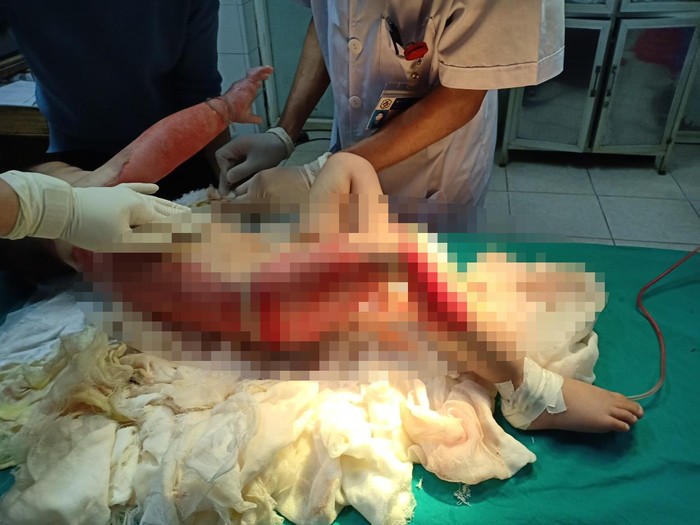 Trẻ bị bỏng toàn thân đang điều trị tại Bệnh viện đa khoa tỉnh Tuyên Quang. (Ảnh: Bệnh viện cung cấp)