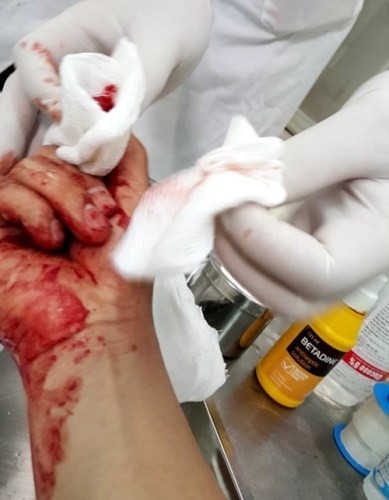 Nhà báo Đỗ Doãn Hoàng bị đánh dập ngón tay. Ảnh: Laodong.com.vn