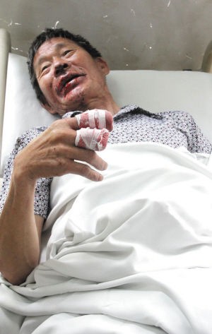Ông Ngô nằm trong bệnh viện với 2 ngón tay kẹp điếu thuốc phát nổ bị cụt 2 đốt, miệng khâu 4 mũi chưa liền