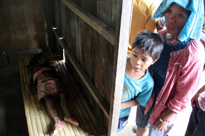 Một bé gái người Philippines mắc bệnh lạ sau những ngày tháng theo bố mẹ đi đãi vàng
