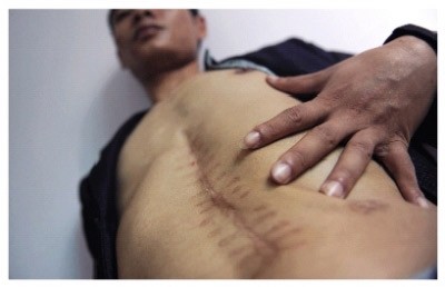 Sẹo sau mổ trên cơ thể Lưu Dũng, người cáo buộc mình bị bác sĩ tự ý cắt mất thận trái