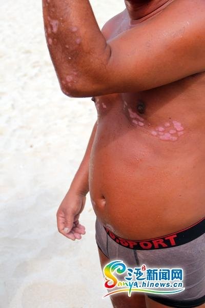 Một người Trung Quốc muốn &quot;tắm truồng, thả rông&quot; trên bãi biển Tam Á cho phóng viên xem những chỗ bị bệnh ngoài da chữa lâu không khỏi.