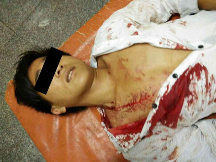 Một người dân Trung Quốc bị thương trong vụ đạn pháo Myanmar lạc qua biên giới đêm Thứ Năm. Ảnh: Đa Chiều.