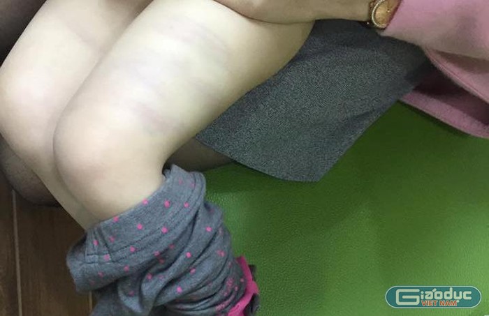Bé gái Phạm Thu Phương (SN 2014, lớp mầm non 3, trường mầm non Thanh Xuân Nam) sau khi tan học có dấu vết bầm tím trên đùi và liên tục kêu đau.