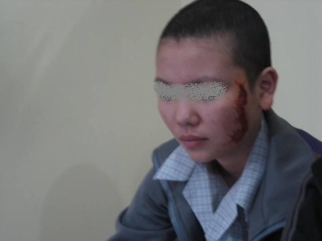 Nguyễn Thị G đang được điểu trị tẩy xăm, phục hồi da tại Hà Nội.