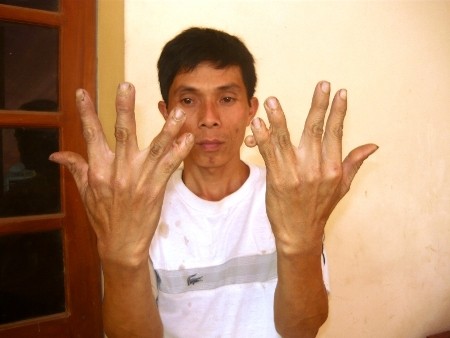 Võ Văn Minh với hai bàn tay thừa ngón và bị dính với nhau. Ảnh: Lê Quyết