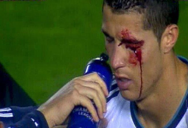 Ronaldo bị Navarro đánh chảy máu mặt.