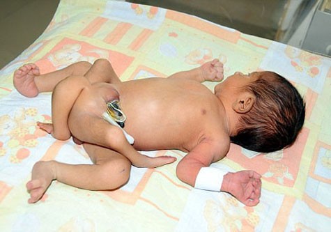 Những đứa trẻ được sinh ra với hình dáng thừa chân.