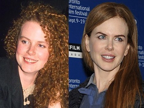 Nicole Kidman là ngôi sao không chỉ chỉnh sửa răng mà cô còn thẩm mỹ môi, bơm botox làm căng da mặt. Xem thêm: Ngắm Sao Việt thuở còn..."răng sữa"/Scarlett Johansson "mất điểm" vì hàm răng ố vàng và mập ú/Thảm họa thẩm mỹ của Sao