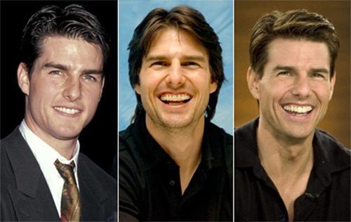 Tom Cruise phải nhờ đến bác sĩ chỉnh răng để có nụ cười đẹp hơn Xem thêm: Ngắm Sao Việt thuở còn..."răng sữa"/Scarlett Johansson "mất điểm" vì hàm răng ố vàng và mập ú/Thảm họa thẩm mỹ của Sao