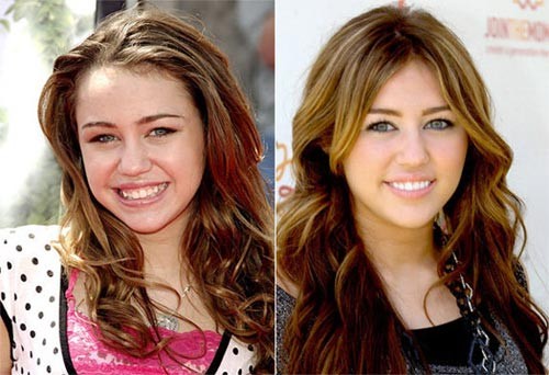 Khi trở thành ngôi sao trẻ của Hollywood thì đương nhiên sẽ nhận được nhiều quan tâm chú ý của công chúng. Đây chính là lý do tại sao Miley Cyrus lại phải đi chỉnh sửa hàm răng của mình