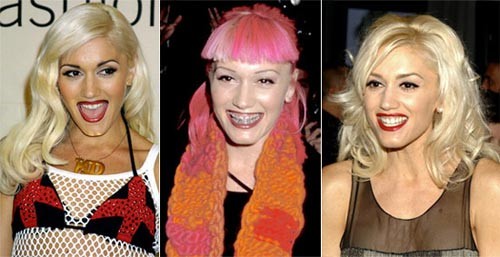 Gwen Stefani phải mất một thời gian khá dài để có hàm răng như ý Xem thêm: Ngắm Sao Việt thuở còn..."răng sữa"/Scarlett Johansson "mất điểm" vì hàm răng ố vàng và mập ú/Thảm họa thẩm mỹ của Sao