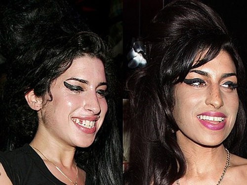 Amy Winehouse đã từng bị mất một chiếc răng và nhờ nha khoa thẩm mỹ cô đã có hàm răng hoàn chỉnh. Chùm ảnh: 2sao
