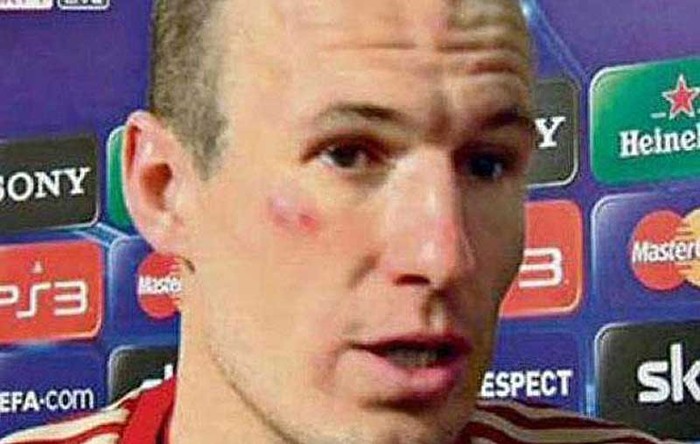 Hệ quả của vụ cãi vã đó là một vết xước trên mặt của Robben, theo tờ nhật báo Bild đưa tin.