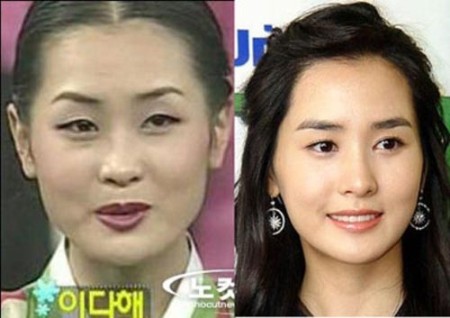 Lee Da Hee là nữ nghệ sĩ hiếm hoi dám công khai thừa nhận "Tôi đã phẫu thuật thẩm mỹ". (Ảnh: tienphong) Xem thên: Sao và những cuộc trùng tu nhan sắc/ Nghệ thuật chăm sóc da tươi sáng, mịn màng.