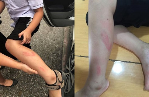Chân em Hoàng Gia Đức (học sinh lớp 2A7, Trường tiểu học Quán Toan) bị cô giáo Trang đánh tím bầm trong giờ kiểm tra (Ảnh: Gia đình cung cấp)