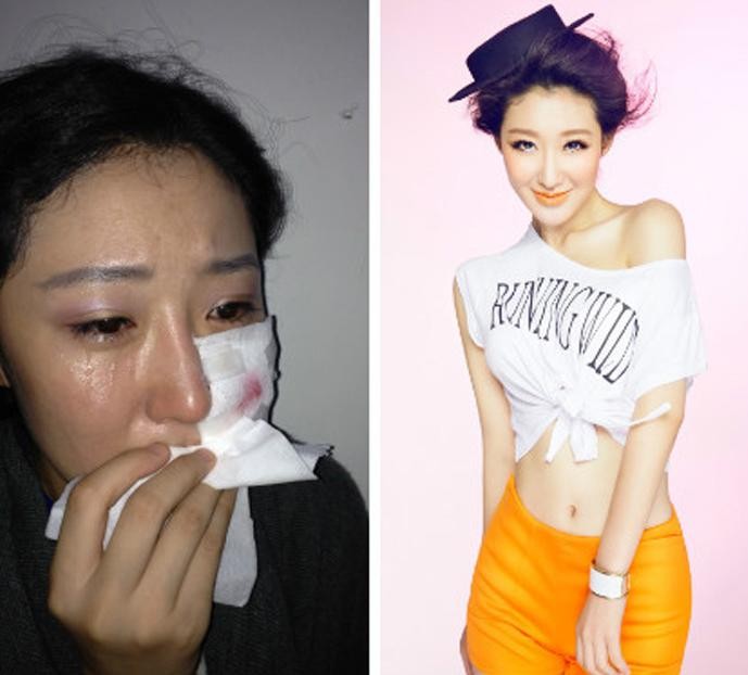 Lý Y Hinh sau vụ tai nạn bị chó ngao Tạng của nữ đồng nghiệp cắn trọng thương (trái) và trước lúc gặp nạn.