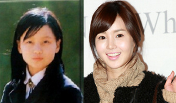 Nữ diễn viên sinh năm 1985 Nam Gyuri có lẽ đã trải qua một cuộc chỉnh sửa xương quai hàm.