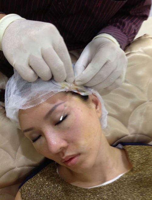 Hình ảnh Hoa hậu Thu Hoài đang được tiến hành căng da bằng chỉ.