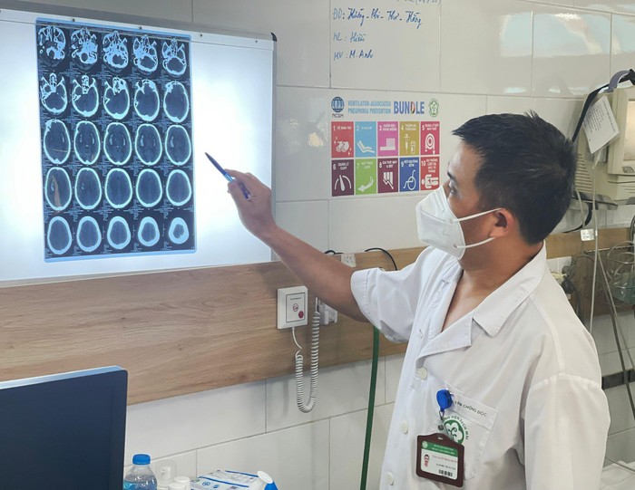 Bác sỹ Nguyễn Trung Nguyên - Giám đốc Trung tâm chống độc Bệnh viện Bạch Mai cho biết, nhiều bệnh nhân tổn thương não do ngộ độc cồn methanol.