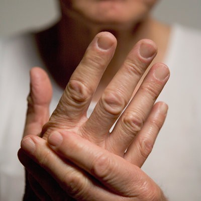 Viêm khớp vẩy nến khiến các đốt ngón tay, ngón chân sưng và đau kéo dài.