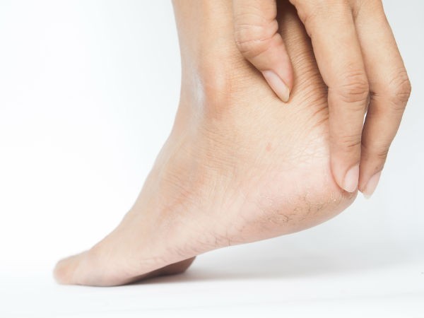 Những cách điều trị nứt gót chân tại nhà hiệu quả (Ảnh: theo boldsky).