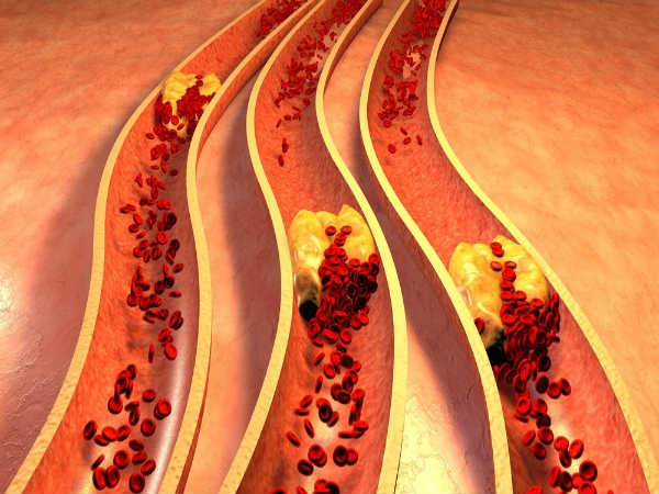 Những người bị cholesterol cao có nguy cơ mắc bệnh tim (Ảnh: theo boldsky).