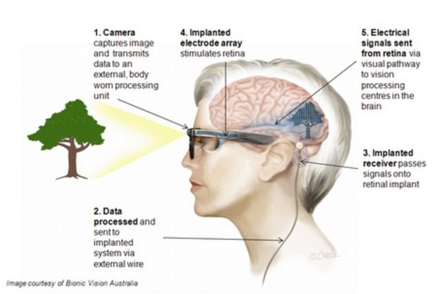 Cách hoạt động: mắt điện tử sử dụng các kính đặc biệt truyền dữ liệu tới một mảng cấy trong não. Thiết bị đã được gắn thành công.
