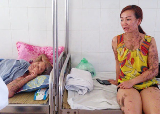 Bà Lý và chị Hương đang được điều trị taị Viện bỏng Quốc gia