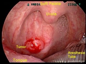 Ung thư vòm họng do hút thuốc lá (ảnh minh họa)
