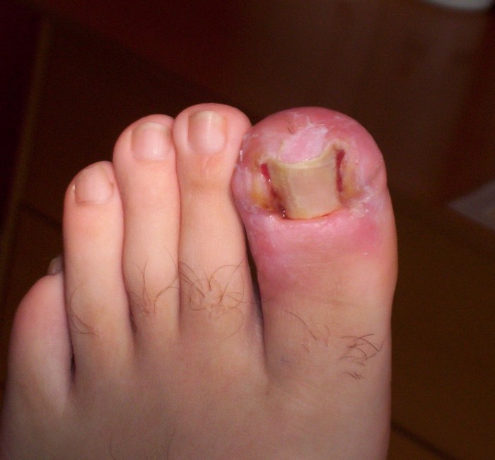 Bệnh móng chọc thịt ở ngón chân/ ingrown toenail