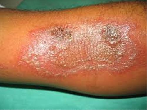 Tác hại khi bị kiến ba khoang tiết dịch lên da