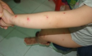 Một trường hợp bị bệnh TCM tại BV Đa khoa tỉnh Ninh Thuận