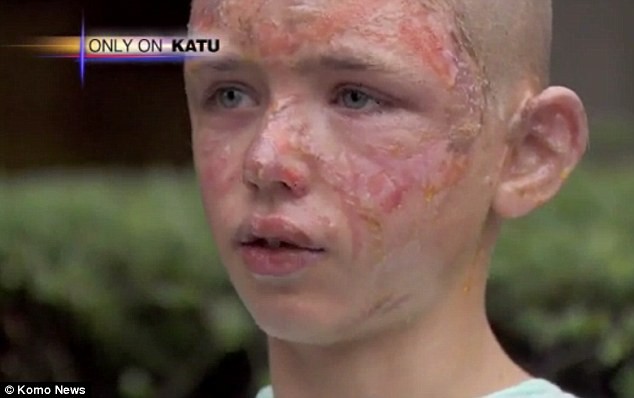 Vì cứu bà, khuôn mặt của bé Seth Cutright đã bị lửa "tàn phá".
